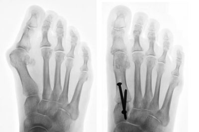 magnetoterapia e alluce valgo: radiografia di un piede con alluce valgo